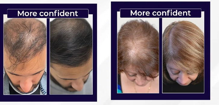 FEG hair growth spray (contains minoxidil)